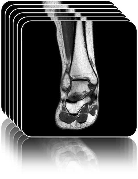 Внешние признаки плоскостопия на рентгене